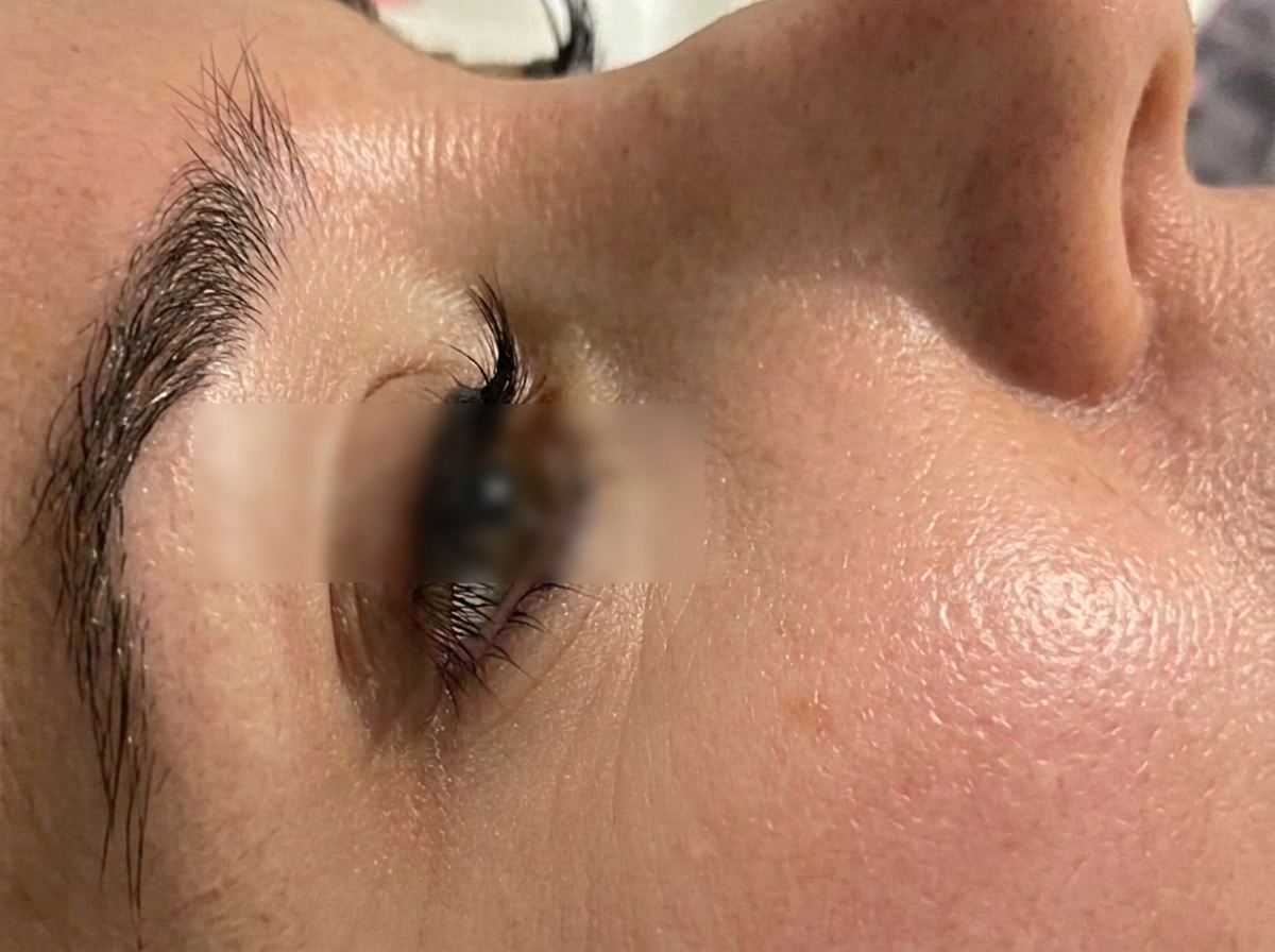 Protocolo facial combinado — después