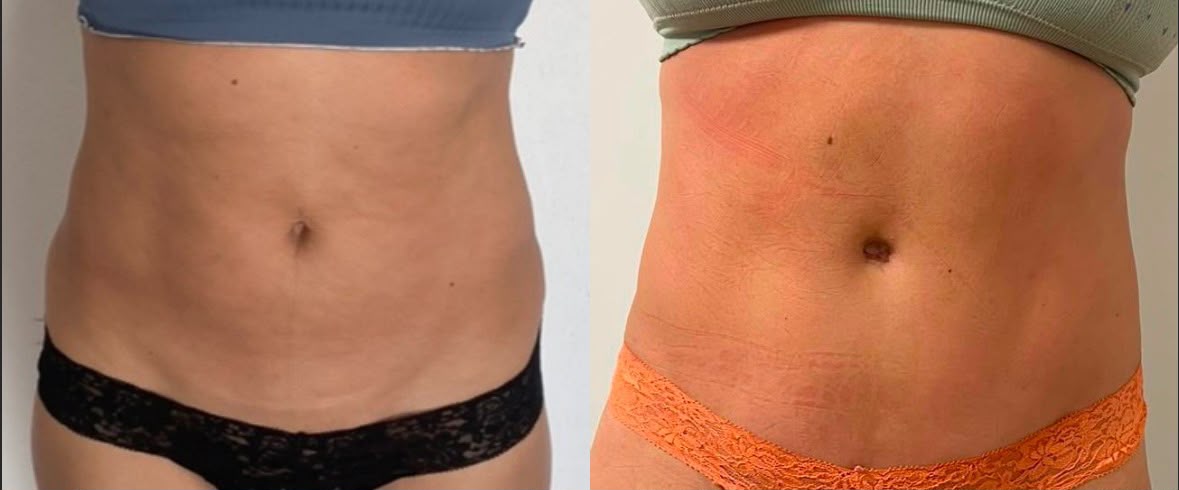 Cryo Sculpt 360 — después